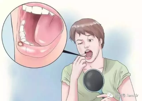 常见的口腔黏膜感染